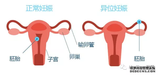 泰安沙雅县患上宫外孕会有哪些征兆呢