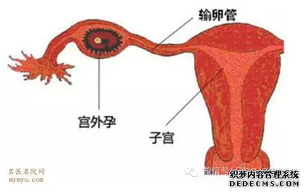 泰安拜城县宫外孕的发病原因有哪些 你了解吗