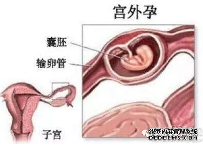 泰安沙雅县关于宫外孕的那点事 你知道多少